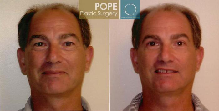 Before & After Facial Procedures for Men Case 104 View #1 View in Orlando, FL