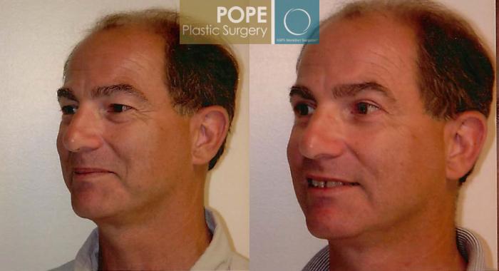 Before & After Facial Procedures for Men Case 104 View #2 View in Orlando, FL