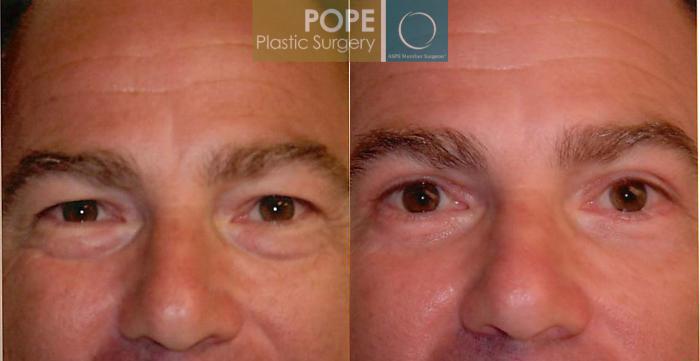 Before & After Facial Procedures for Men Case 104 View #3 View in Orlando, FL