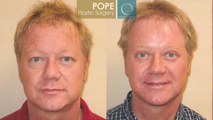 Before & After Facial Procedures for Men Case 105 View #1 View in Orlando, FL