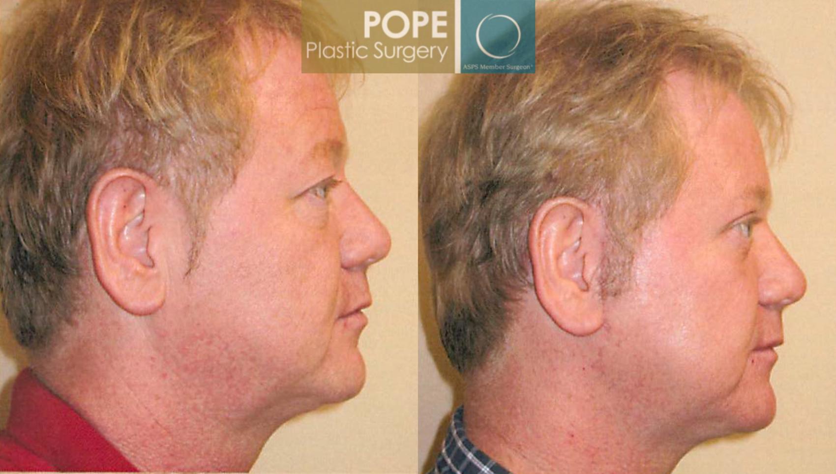 Before & After Facial Procedures for Men Case 105 View #2 View in Orlando, FL