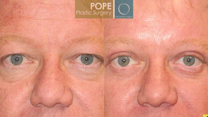 Before & After Facial Procedures for Men Case 105 View #3 View in Orlando, FL