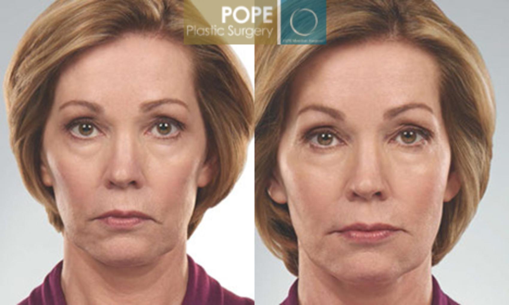 Before & After JUVÉDERM® Case 61 View #1 View in Orlando, FL