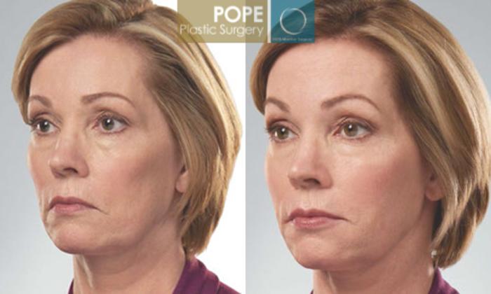Before & After JUVÉDERM® Case 61 View #2 View in Orlando, FL