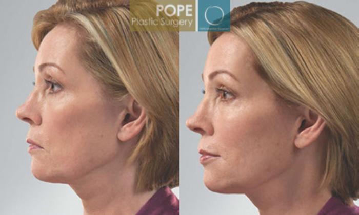 Before & After JUVÉDERM® Case 61 View #3 View in Orlando, FL