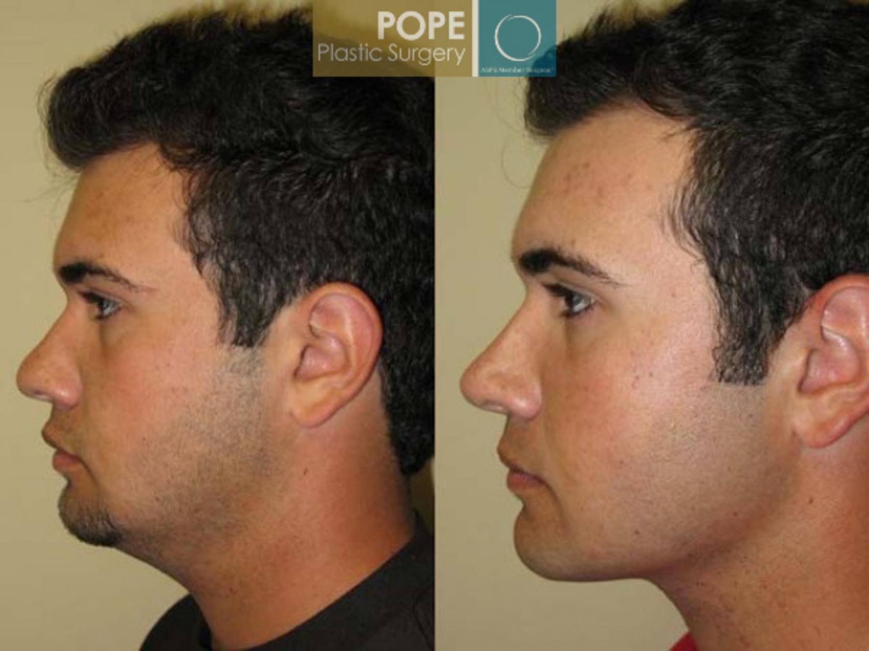 Before & After Liposuction Case 165 View #1 View in Orlando, FL