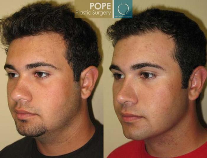 Before & After Liposuction Case 165 View #2 View in Orlando, FL