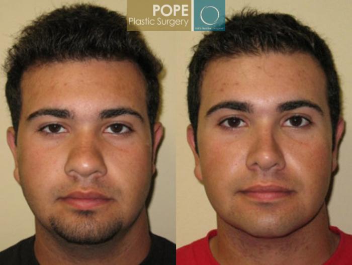 Before & After Liposuction Case 165 View #3 View in Orlando, FL