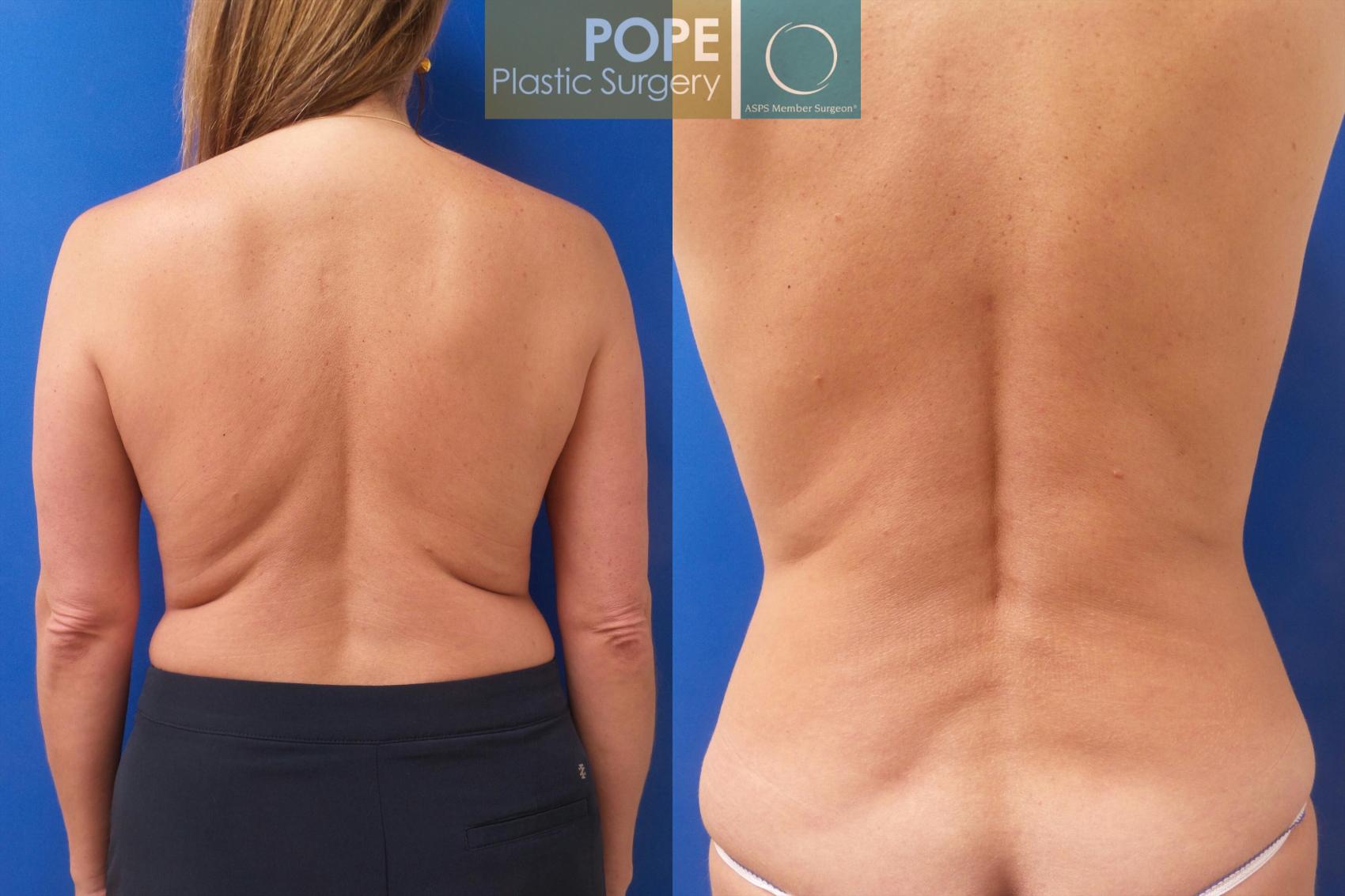 Before & After Liposuction Case 194 Back View in Orlando, FL