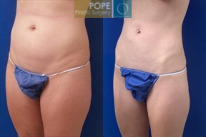 Before liposuction of flanks and abdomen