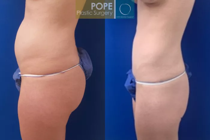 Abdominoplasty and Liposuction Thighs and Flanks Case 92109 - The Plastic  Surgery Group