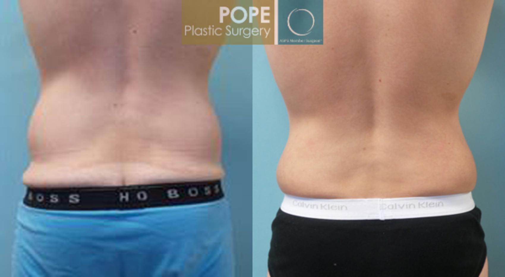Before & After Liposuction Case 55 View #1 View in Orlando, FL