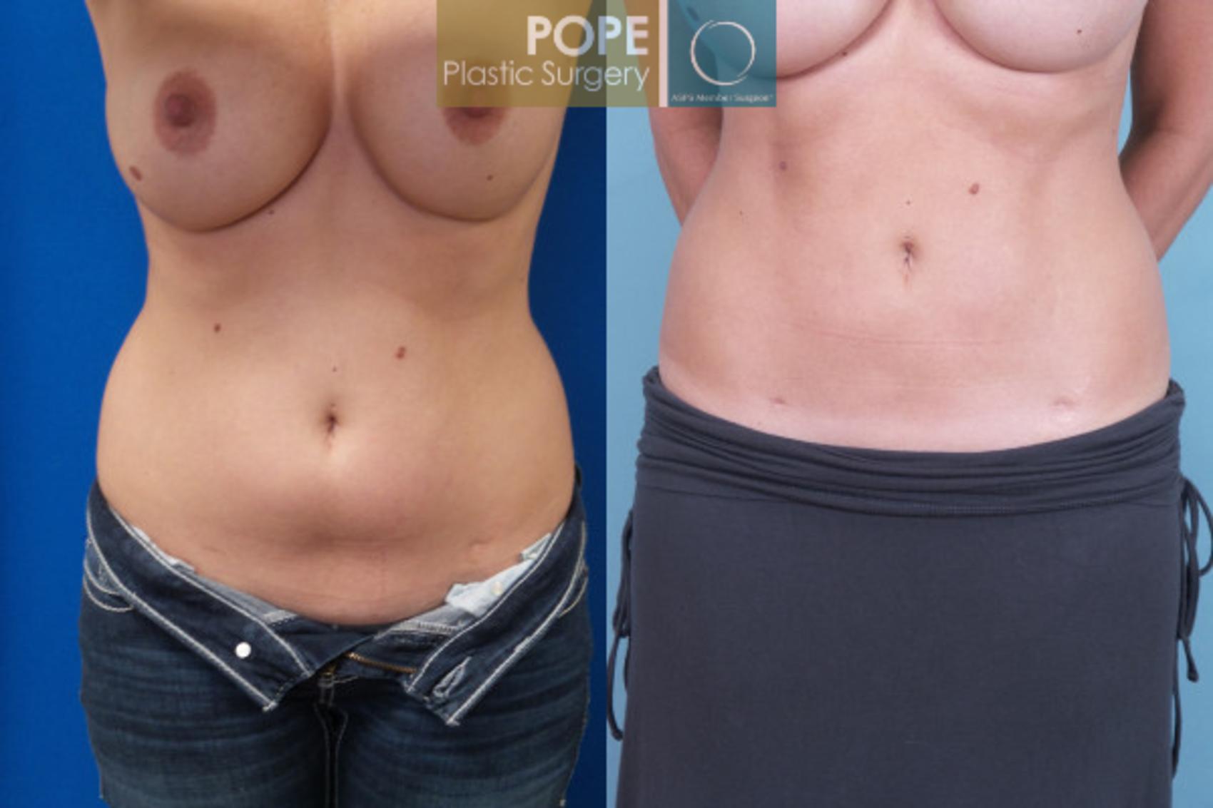 Before & After Liposuction Case 56 View #1 View in Orlando, FL