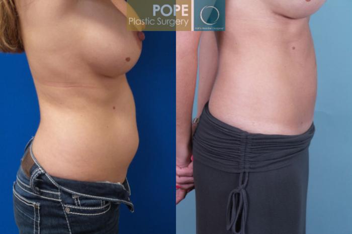 Before & After Liposuction Case 56 View #2 View in Orlando, FL