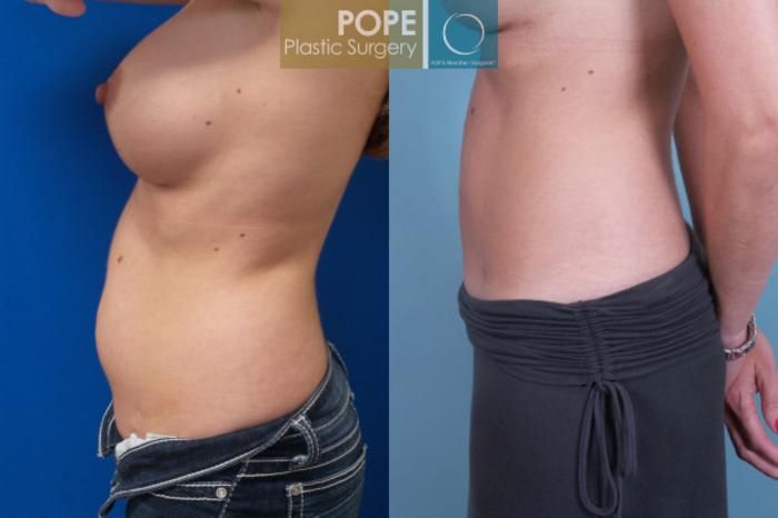 Before & After Liposuction Case 56 View #3 View in Orlando, FL