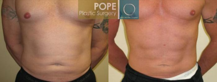 Before & After Liposuction Case 57 View #1 View in Orlando, FL