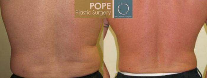Before & After Liposuction Case 57 View #2 View in Orlando, FL