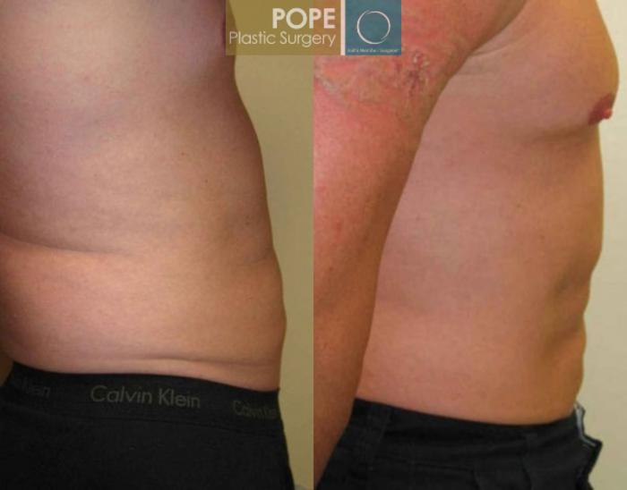 Before & After Liposuction Case 57 View #3 View in Orlando, FL