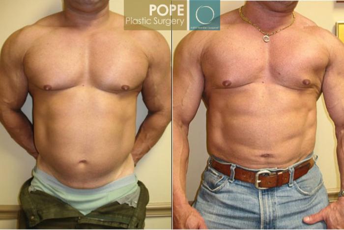 Before & After Liposuction Case 58 View #1 View in Orlando, FL