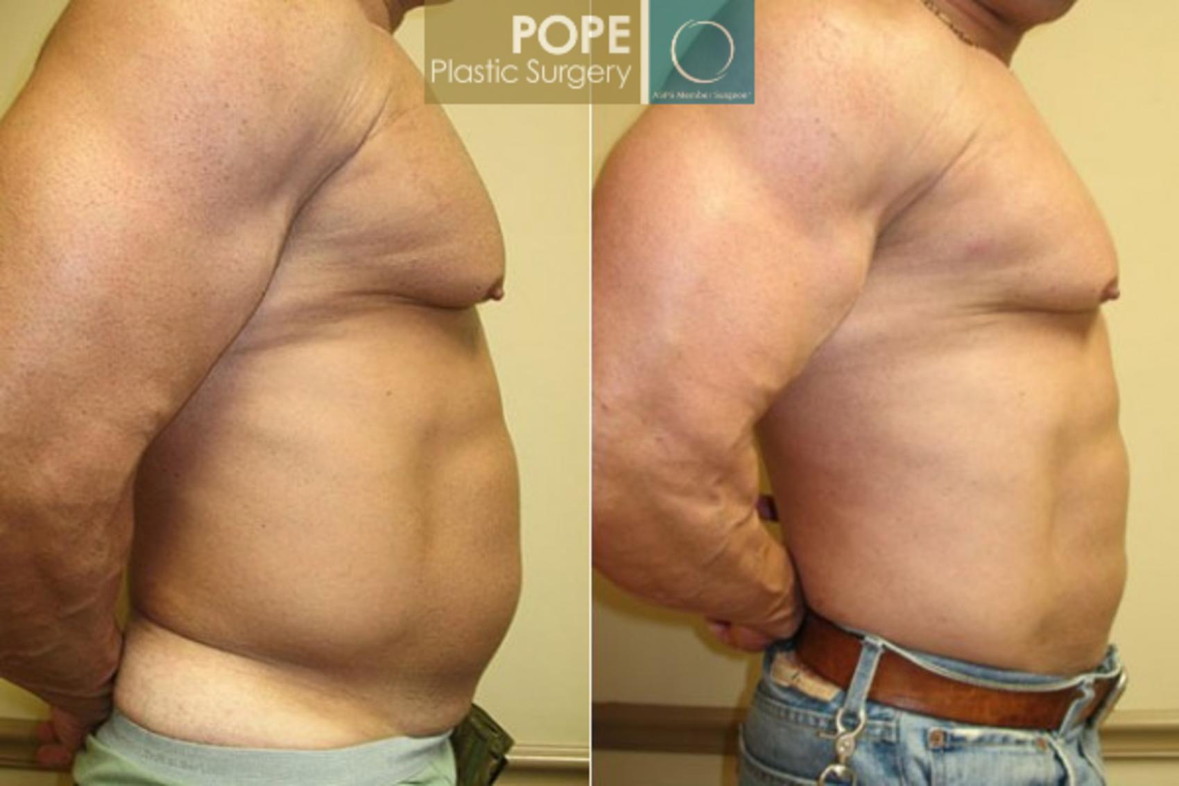 Before & After Liposuction Case 58 View #2 View in Orlando, FL
