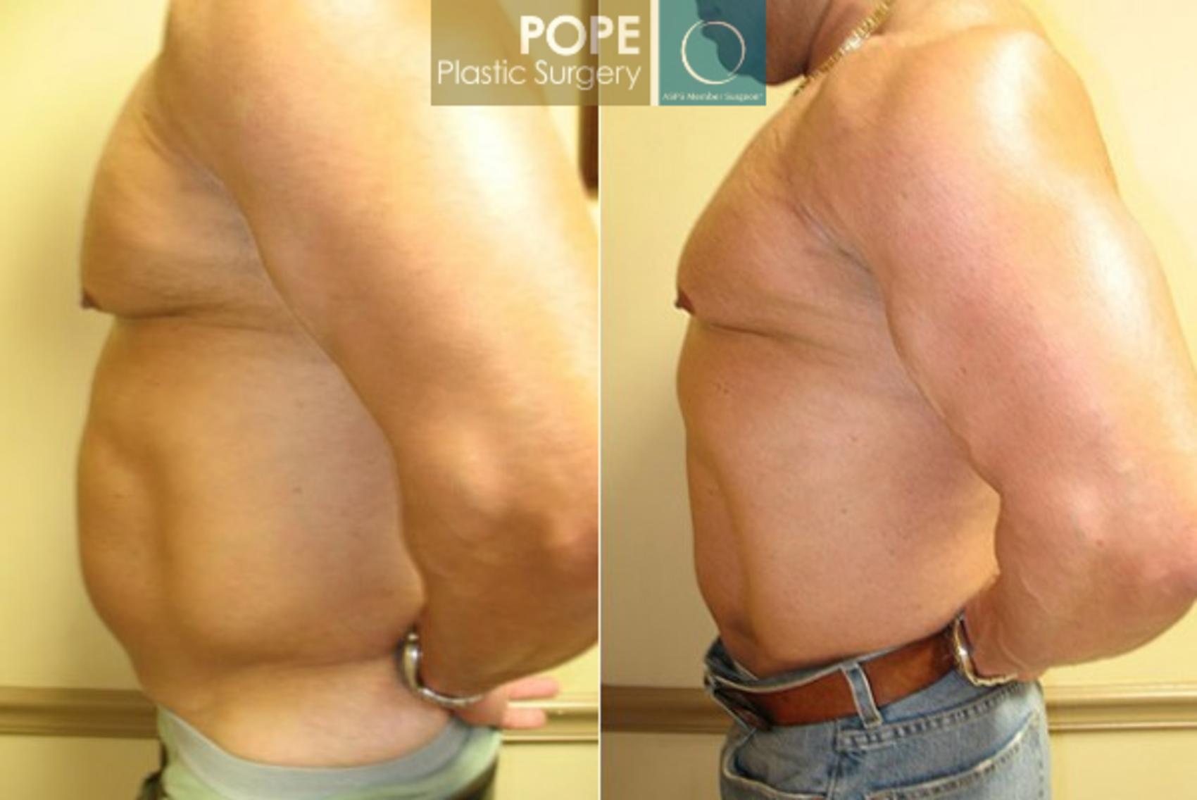 Before & After Liposuction Case 58 View #3 View in Orlando, FL