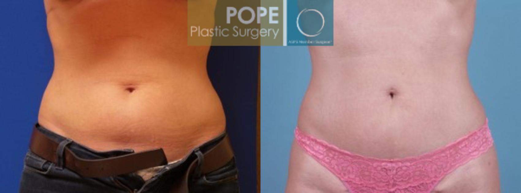 Before & After Liposuction Case 59 View #1 View in Orlando, FL