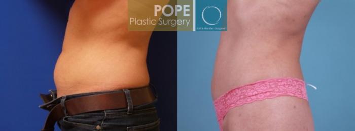 Before & After Liposuction Case 59 View #2 View in Orlando, FL