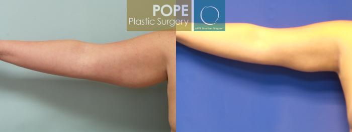 Before & After Liposuction Case 74 View #1 View in Orlando, FL