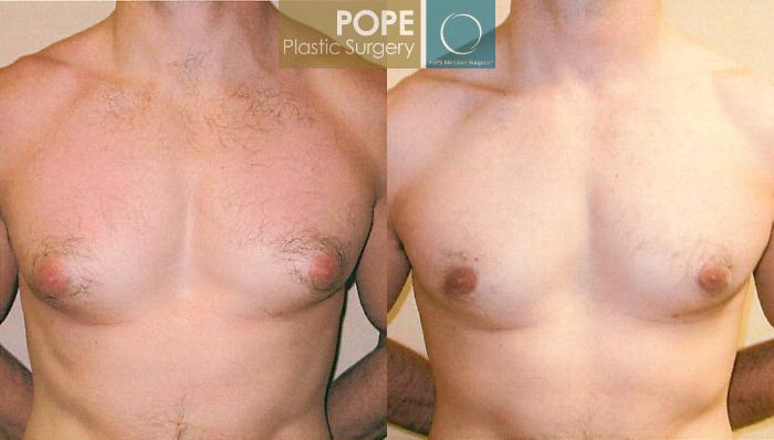 Before & After Male Breast Reduction Case 100 View #1 View in Orlando, FL