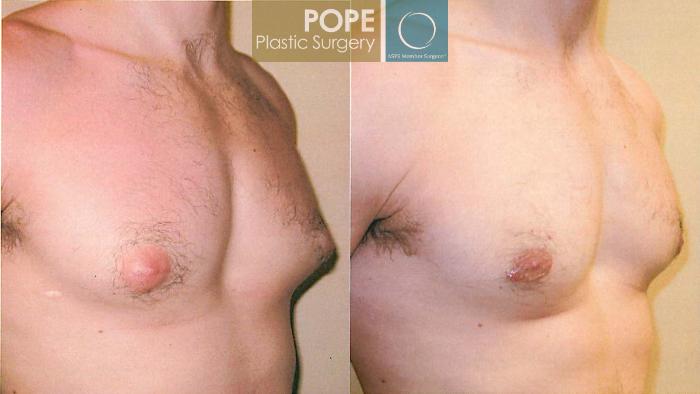 Before & After Male Breast Reduction Case 100 View #2 View in Orlando, FL