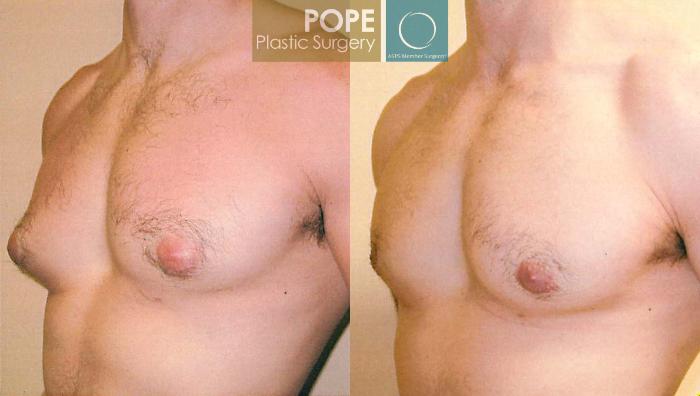 Before & After Male Breast Reduction Case 100 View #3 View in Orlando, FL