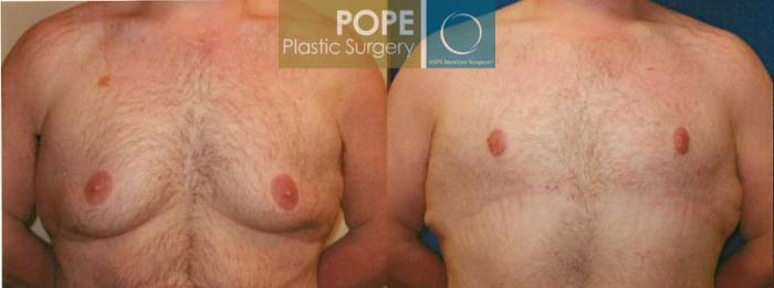 Before & After Male Breast Reduction Case 101 View #1 View in Orlando, FL