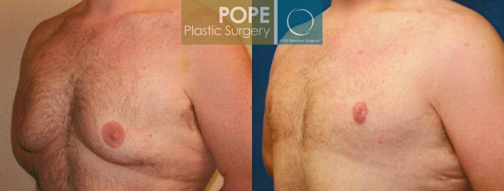 Before & After Male Breast Reduction Case 101 View #2 View in Orlando, FL