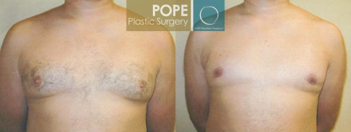 Before & After Male Breast Reduction Case 102 View #1 View in Orlando, FL