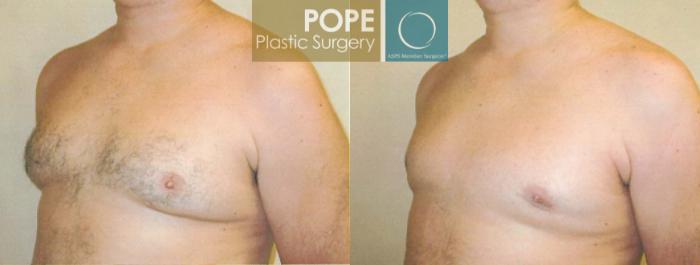 Before & After Male Breast Reduction Case 102 View #2 View in Orlando, FL