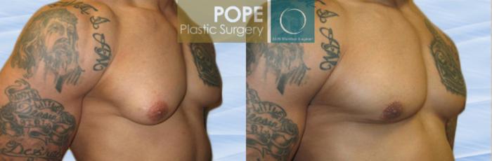 Before & After Male Breast Reduction Case 145 View #2 View in Orlando, FL