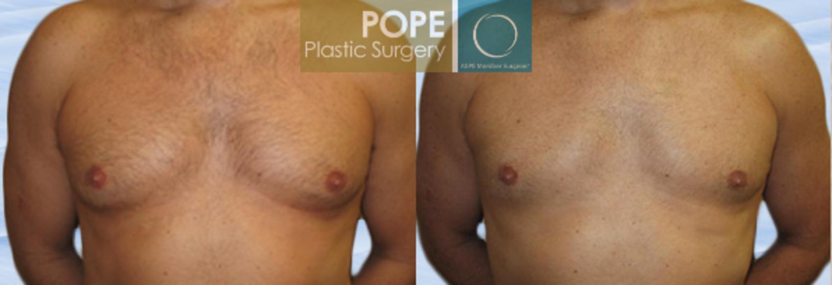 Before & After Male Breast Reduction Case 146 View #1 View in Orlando, FL