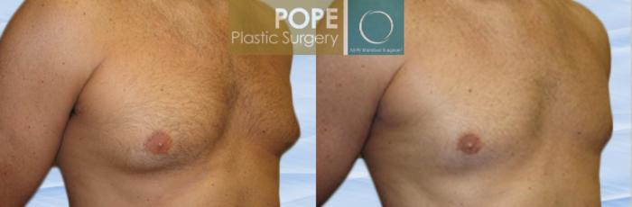 Before & After Male Breast Reduction Case 146 View #2 View in Orlando, FL