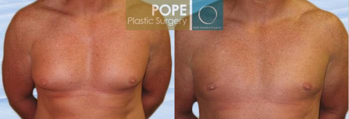 Before & After Male Breast Reduction Case 147 View #1 View in Orlando, FL