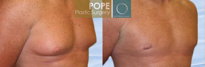 Before & After Male Breast Reduction Case 147 View #2 View in Orlando, FL