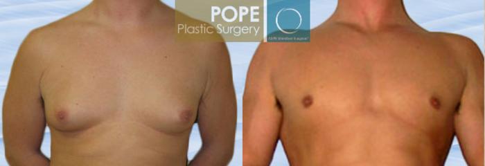 Before & After Male Breast Reduction Case 148 View #1 View in Orlando, FL