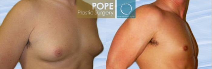 Before & After Male Breast Reduction Case 148 View #2 View in Orlando, FL