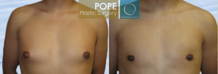 Before & After Male Breast Reduction Case 149 View #1 View in Orlando, FL