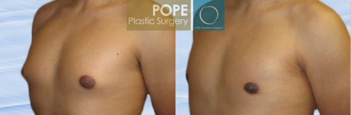 Before & After Male Breast Reduction Case 149 View #2 View in Orlando, FL