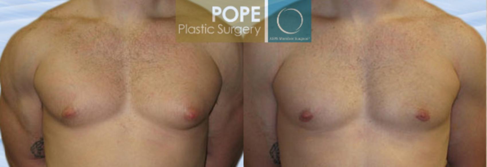 Before & After Male Breast Reduction Case 150 View #1 View in Orlando, FL