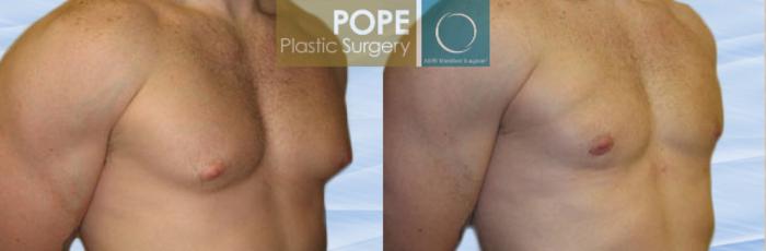 Before & After Male Breast Reduction Case 150 View #2 View in Orlando, FL