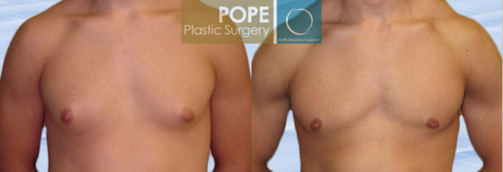 Before & After Male Breast Reduction Case 151 View #1 View in Orlando, FL