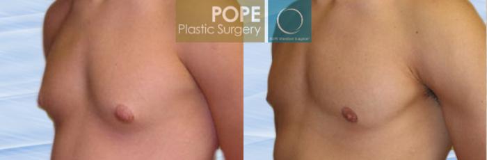 Before & After Male Breast Reduction Case 151 View #2 View in Orlando, FL