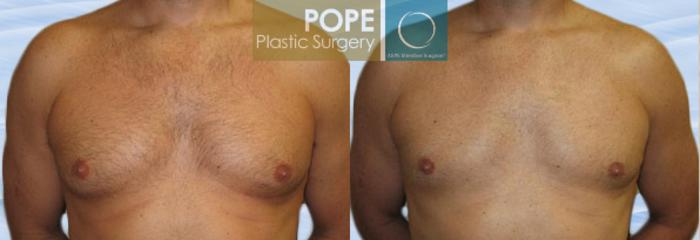 Before & After Male Breast Reduction Case 152 View #1 View in Orlando, FL
