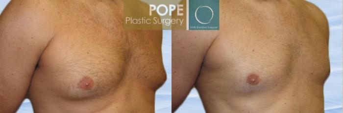 Before & After Male Breast Reduction Case 152 View #2 View in Orlando, FL